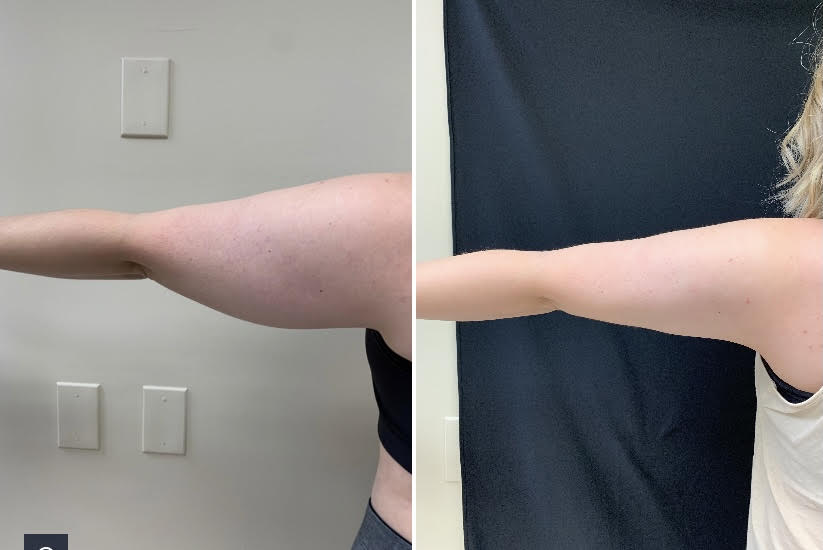 Posterior View Arms liposuction Drew Varano MD Posterior View Arms liposuction Drew Varano MD
